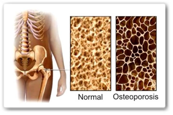 Phelps Memorial Hospital Center has opened its new Osteoporosis Center. 