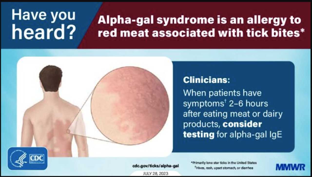 Tickborne illness causes allergy to red meat cdc warns stamford