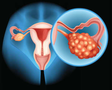 Ovarian cancer, which often goes unnoticed, is deadly. However, early detection increases the likelihood of survival.